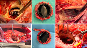 Endocarditis protésica aórtica: a) dehiscencia periprotésica por EPV, b) prótesis mecánica aórtica infectada explantada, c) reconstrucción del anillo valvular con pericardio heterólogo, d) EPV mitral, e) prótesis mitral mecánica infectada explantada y f) integridad periprotésica mitral con vegetación en anillo de sutura.