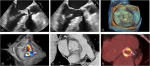 Endocarditis protésica: a) ETE-2D: vegetación protésica aórtica en tracto de salida del ventrículo izquierdo en diástole, b) la misma vegetación con protusión sistólica en la aorta, c) ETE-3D vegetaciones en EPV mitral, d) ETE-3D: fuga periprotésica en EPV mitral, e) TC cardiaca, corte axial: absceso periprotésico aórtico y f) PET con 18F-FDG: hipercaptación multifocal y heterogénea sobre TAVI balón-expandible.