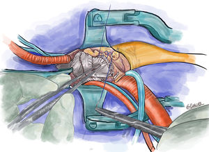 Técnica segunda línea de sutura de refuerzo de la anastomosis proximal.