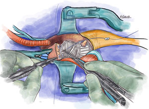 Técnica segunda línea de sutura de refuerzo de la anastomosis distal.