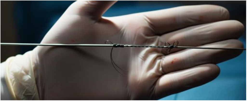 Selectsecure Extracción de electrodos «lumen-less» SelectSecure 3830 Medtronic® en ...