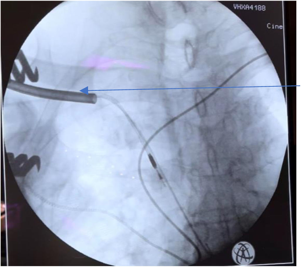 Selectsecure Extracción de electrodos «lumen-less» SelectSecure 3830 Medtronic® en ...
