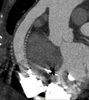 AngioTC postoperatoria donde se evidencia la disfunción de la estenosis.