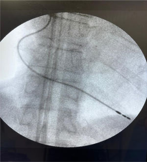 Fluoroscopia ventricular derecha donde se observa electrodo colocado adecuadamente hacia el ápex.