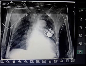 Radiografía de tórax al alta médica.