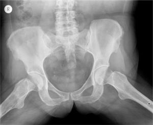 Se puede apreciar una lesión osteolítica en cresta ilíaca.