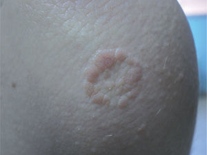 Granuloma Anular Dos Formas Cl nicas FMC Formaci n M dica 