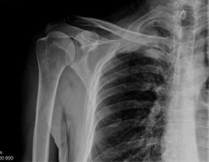 Radiografía anteroposterior de hombro afecto de paciente 1 en urgencias. Se evidencia posible ocupación pulmonar derecha.
