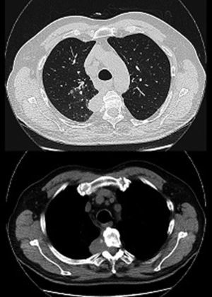 Tomografía computarizada torácica de paciente 2, tras tratamiento médico que muestra respuesta parcial muy importante.