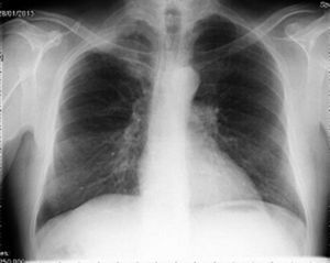 Radiografía de tórax de paciente 1 en urgencias que muestra masa en vértice pulmonar derecho.
