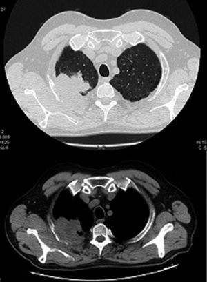 Tomografía computarizada torácica de paciente 1 en urgencias, que evidencia masa en vértice pulmonar derecho de 8cm con adenopatías asociadas e invasión pleural y segundo arco costal.