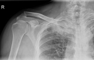 Radiografía anteroposterior de hombro afecto de paciente 2 en urgencias, que muestra posible ocupación pulmonar derecha.