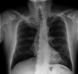 Radiografía de tórax de paciente 2 en urgencias que muestra masa en vértice pulmonar derecho.