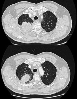 Tomografía computarizada torácica de paciente 2 en urgencias, que evidencia masa en vértice pulmonar derecho de 6cm con engrosamiento pleural bilateral y adenopatías mediastínicas.
