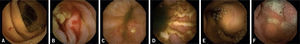 Imágenes de cápsula endoscópica. A) Angiodisplasia yeyunal sangrante en paciente con anemia ferropénica. B) Angiodisplasia yeyunal con sangrado activo. C) Úlcera y eritema yeyunal en paciente con sospecha de enfermedad de Crohn. D) Múltiples úlceras en paciente con enfermedad de Crohn ya conocida. E) Tumor submucoso. F) Pólipo yeyunal. Imágenes de cápsula endoscópica. A) Angiodisplasia yeyunal sangrante en paciente con anemia ferropénica. B) Angiodisplasia yeyunal con sangrado activo. C) Úlcera y eritema yeyunal en paciente con sospecha de enfermedad de Crohn. D) Múltiples úlceras en paciente con enfermedad de Crohn ya conocida. E) Tumor submucoso. F) Pólipo yeyunal.