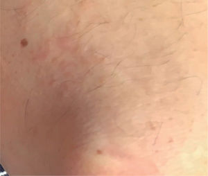 Se pueden apreciar lesiones vesiculares pruriginosas de aspecto y disposición herpetiforme, típicas de la dermatitis herpetiforme. Se pueden apreciar lesiones vesiculares pruriginosas de aspecto y disposición herpetiforme, típicas de la dermatitis herpetiforme.