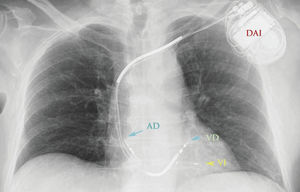 Desfibrilador automático implantable.AD: aurícula derecha; DAI: desfibrilador automático implantable; VD: ventrículo derecho; VI: ventrículo izquierdo.