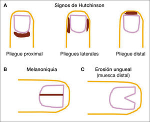 Esquemas del signo de Hutchinson (A), melanoniquia (B) y erosión ungueal (C). El signo de Hutchinson es una pigmentación de la piel que rodea la uña. En la melanoniquia observamos una banda recta que se extiende de pliegue proximal a distal incluido. En una erosión ungueal vemos destrucción/desaparición de la uña a nivel distal. Esquemas del signo de Hutchinson (A), melanoniquia (B) y erosión ungueal (C). El signo de Hutchinson es una pigmentación de la piel que rodea la uña. En la melanoniquia observamos una banda recta que se extiende de pliegue proximal a distal incluido. En una erosión ungueal vemos destrucción/desaparición de la uña a nivel distal.