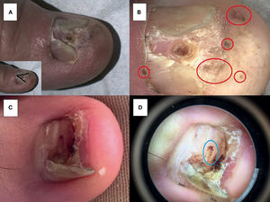 Melanoma ungueal (A y B) y uña traumática (C y D). Las imágenes A (clínica) y B (dermatoscopia) corresponden a la misma lesión. Observamos erosión ungueal en A (línea negra), y signo de Hutchinson en B (círculos rojos). Aunque en C observamos destrucción de la uña, el paciente explicaba un claro antecedente de hematoma ungueal seguido por desprendimiento de la uña. Con dermatoscopio (D) se observan pequeñas gotas de sangre en el círculo azul (hematoma subungueal). Melanoma ungueal (A y B) y uña traumática (C y D). Las imágenes A (clínica) y B (dermatoscopia) corresponden a la misma lesión. Observamos erosión ungueal en A (línea negra), y signo de Hutchinson en B (círculos rojos). Aunque en C observamos destrucción de la uña, el paciente explicaba un claro antecedente de hematoma ungueal seguido por desprendimiento de la uña. Con dermatoscopio (D) se observan pequeñas gotas de sangre en el círculo azul (hematoma subungueal).