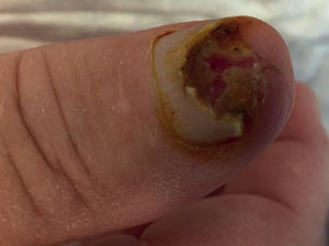 Carcinoma escamoso de la uña del dedo pulgar. Observamos erosión/destrucción de la uña por el tumor. No explicaba ningún traumatismo previo que pudiera justificar esta erosión. Carcinoma escamoso de la uña del dedo pulgar. Observamos erosión/destrucción de la uña por el tumor. No explicaba ningún traumatismo previo que pudiera justificar esta erosión.