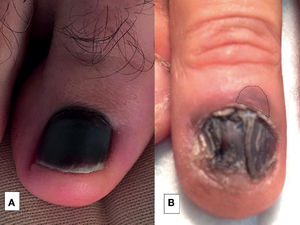 Hematoma subungueal (A) y melanoma (B). A simple vista ambas imágenes son parecidas, pero en B observamos un sutil signo de Hutchinson (línea discontinua). Hematoma subungueal (A) y melanoma (B). A simple vista ambas imágenes son parecidas, pero en B observamos un sutil signo de Hutchinson (línea discontinua).