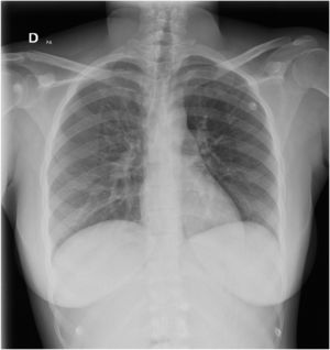Radiografía de tórax anteroposterior con mínimo infiltrado alveolar en base derecha, senos costodiafragmáticos libres y silueta cardiomediastínica conservada.