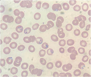 Frotis de sangre con colorante de Giemsa que muestra trofozoítos en forma de anillo de Plasmodium falciparum.
