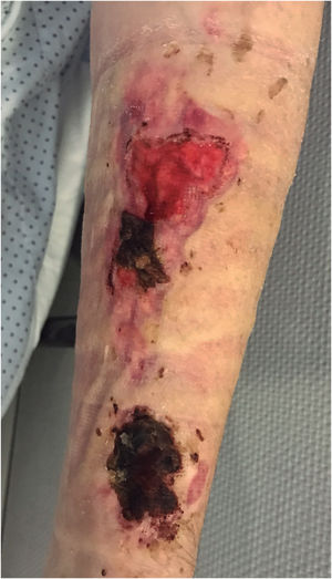 Lesiones superficiales con restos necróticos y zonas desbridadas sobre la cicatriz.