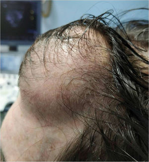 Tumoración blanda en la región frontal izquierda. Tumoración blanda en la región frontal izquierda.