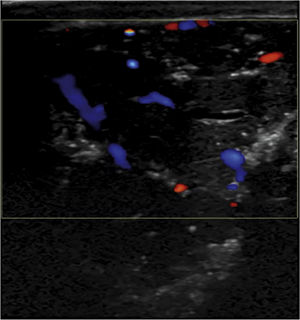 Ecografía que muestra una lesión de ecogenicidad heterogénea, con múltiples calcificaciones. Ecografía que muestra una lesión de ecogenicidad heterogénea, con múltiples calcificaciones.
