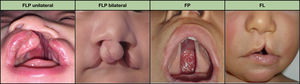 Tipos de fisuras orofaciales. FL: fisura labial; FLP: fisura labiopalatina; FP: Fisura palatina.