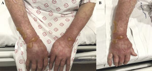 Ambas imágenes pertenecen a una mujer de 82 años que acudió a urgencias al presentar estas lesiones tras la poda de una planta de ruda (Ruta graveolens) 3 días antes. Reconoció a su vez una exposición solar durante y después de dicha actividad. A) Destacan lesiones en ambos dorsos de mano y antebrazos, regiones fotoexpuestas. B) Imagen más ampliada de la extremidad con mayor afectación, donde se observan lesiones vesiculoampollosas sobre piel eritematosa, similares a quemaduras de segundo grado. Ambas imágenes pertenecen a una mujer de 82 años que acudió a urgencias al presentar estas lesiones tras la poda de una planta de ruda (Ruta graveolens) 3 días antes. Reconoció a su vez una exposición solar durante y después de dicha actividad. A) Destacan lesiones en ambos dorsos de mano y antebrazos, regiones fotoexpuestas. B) Imagen más ampliada de la extremidad con mayor afectación, donde se observan lesiones vesiculoampollosas sobre piel eritematosa, similares a quemaduras de segundo grado.