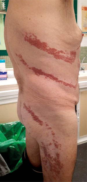 Enfermedad de Grover en región torácica- raíz de miembros. Enfermedad de Grover en región torácica- raíz de miembros.