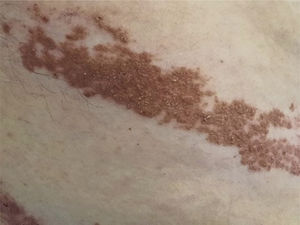 Enfermedad de Grover del paciente anterior, visualizando las lesiones a mayor aumento. Enfermedad de Grover del paciente anterior, visualizando las lesiones a mayor aumento.