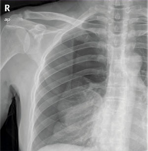 Radiografía de tórax posteroanterior. Se visualiza parénquima pulmonar reducido a la región basal con ausencia de trama broncovascular en región superior y media de hemitórax derecho. Radiografía de tórax posteroanterior. Se visualiza parénquima pulmonar reducido a la región basal con ausencia de trama broncovascular en región superior y media de hemitórax derecho.