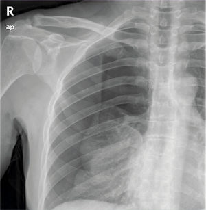 Radiografía de tórax posteroanterior. Se visualiza parénquima pulmonar reducido a la región basal con ausencia de trama broncovascular en región superior y media de hemitórax derecho.