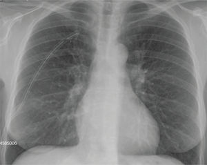 Radiografía de tórax de control con tubo de drenaje donde se observa expansión pulmonar. Radiografía de tórax de control con tubo de drenaje donde se observa expansión pulmonar.