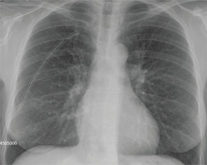 Radiografía de tórax de control con tubo de drenaje donde se observa expansión pulmonar.
