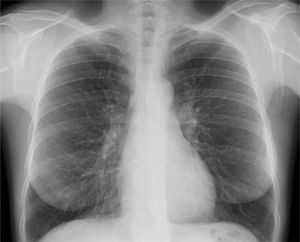 Radiografía de tórax tras retirada del tubo de drenaje donde se objetiva el parénquima pulmonar en todo el hemitórax derecho. Resolución completa del cuadro. Radiografía de tórax tras retirada del tubo de drenaje donde se objetiva el parénquima pulmonar en todo el hemitórax derecho. Resolución completa del cuadro.
