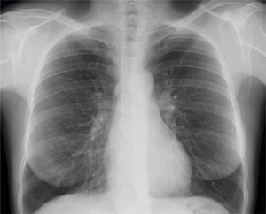 Radiografía de tórax tras retirada del tubo de drenaje donde se objetiva el parénquima pulmonar en todo el hemitórax derecho. Resolución completa del cuadro.