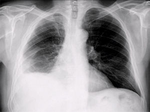 Disminución de volumen del pulmón derecho. Disminución de volumen del pulmón derecho.