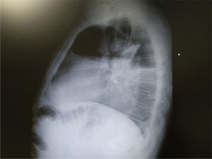 Ángulo costofrénico borrado. Ángulo costofrénico borrado.