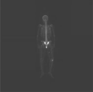 Gammagrafía ósea. Estudio isotópico con imágenes hipercaptantes en ambas alas sacras.