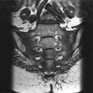 Resonancia magnética sacrocoronal T1. Afectación de la señal medular ósea con imágenes lineales de tractos de fractura de ambas alas sacras.