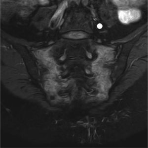 Resonancia magnética sacrocoronal STiR. Hiperseñal de ambas alas sacras correspondiente con edema en relación con fracturas por insuficiencia ósea en un hueso radiado.