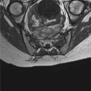 Resonancia magnética sacroaxial T1. Alteración de la señal medular ósea con tractos de fractura muy evidentes en ala sacra izquierda, y alteración de la señal grasa del área glútea correspondiente a fístula.