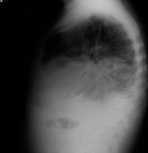 Radiografía lateral de tórax al segundo ingreso.