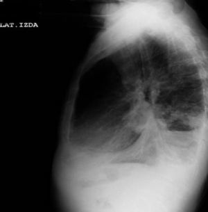 Radiografía 2. Lateral de tórax.