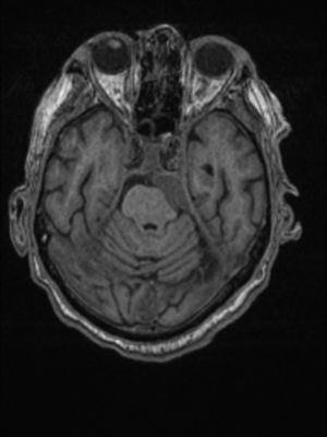 Resonancia magnética cerebral en plano axial: Imagen obtenida en secuencia T1 sin contraste.