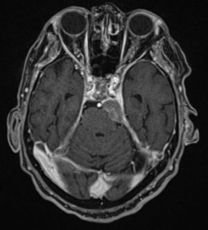 Resonancia magnética cerebral en plano axial: Imagen obtenida en secuencia T2 con gadolinio.